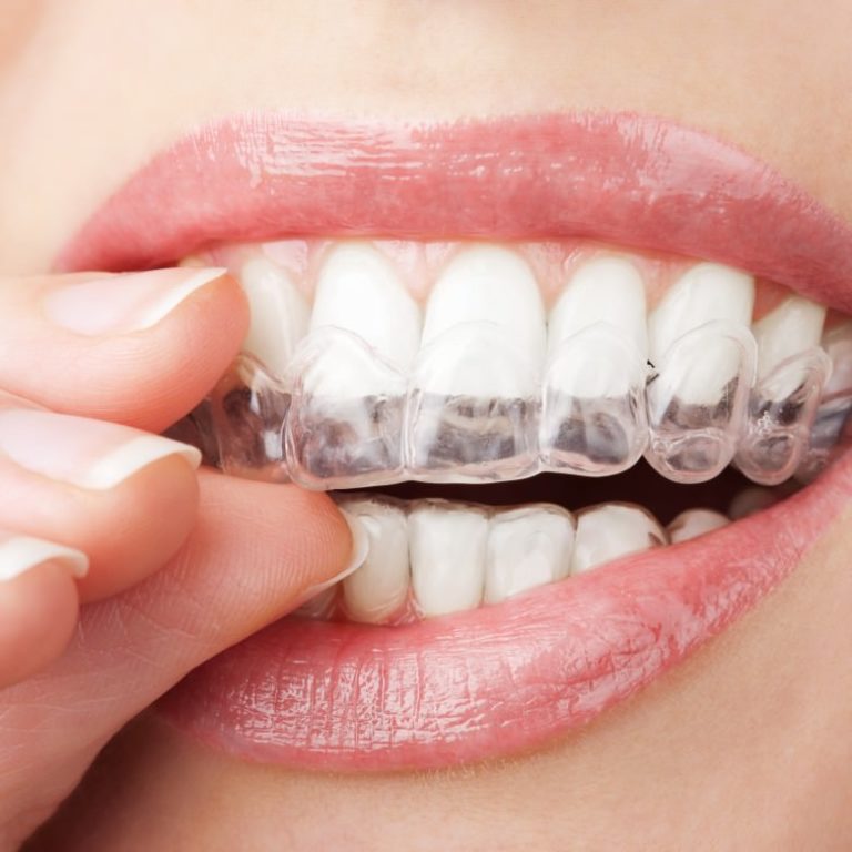 Pourquoi choisir l’orthodontie invisalign ? Pourquoi choisir l’orthodontie invisalign ?